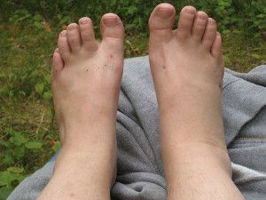 Learn More Common Injuries From Hiking